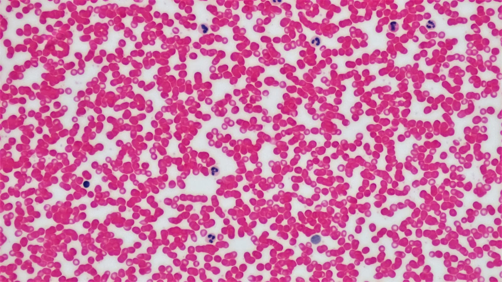 Porozumenie Sickle Cell kríze: VOC, ACS a núdzové stavy